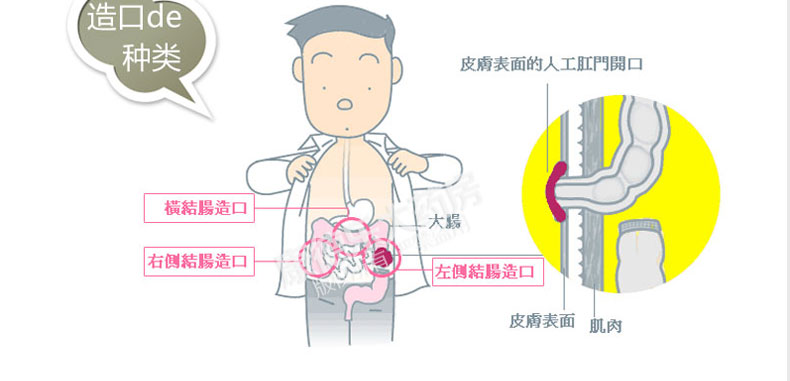 康樂保特舒二件式造口底盤 2832